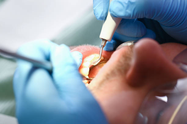 Best Emergency Root Canal Treatment in Bellmore, NY